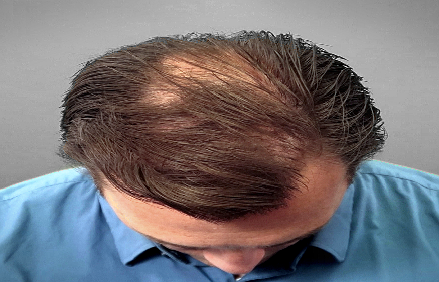 The  Best Hair Loss Products